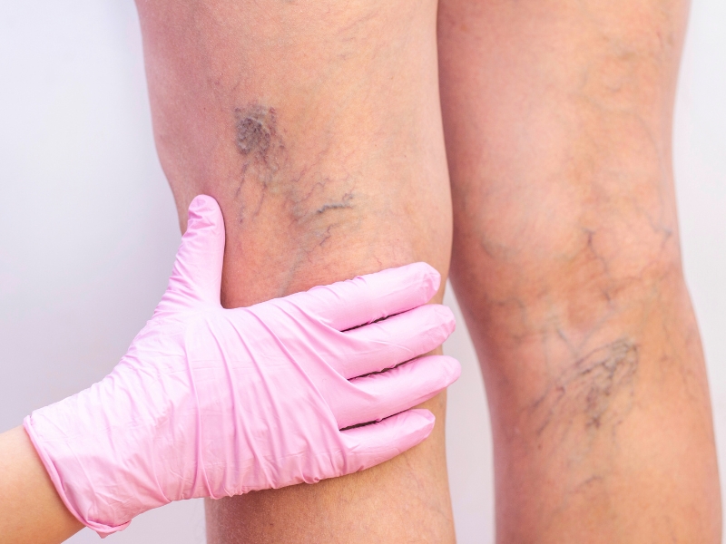 melhor angiologista em Salvador